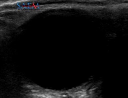 SAEM Clinical Images Series: Retrobulbar Spot Sign