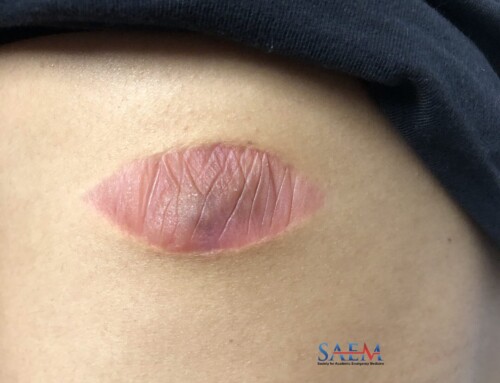 SAEM Clinical Images Series: Back Lesion