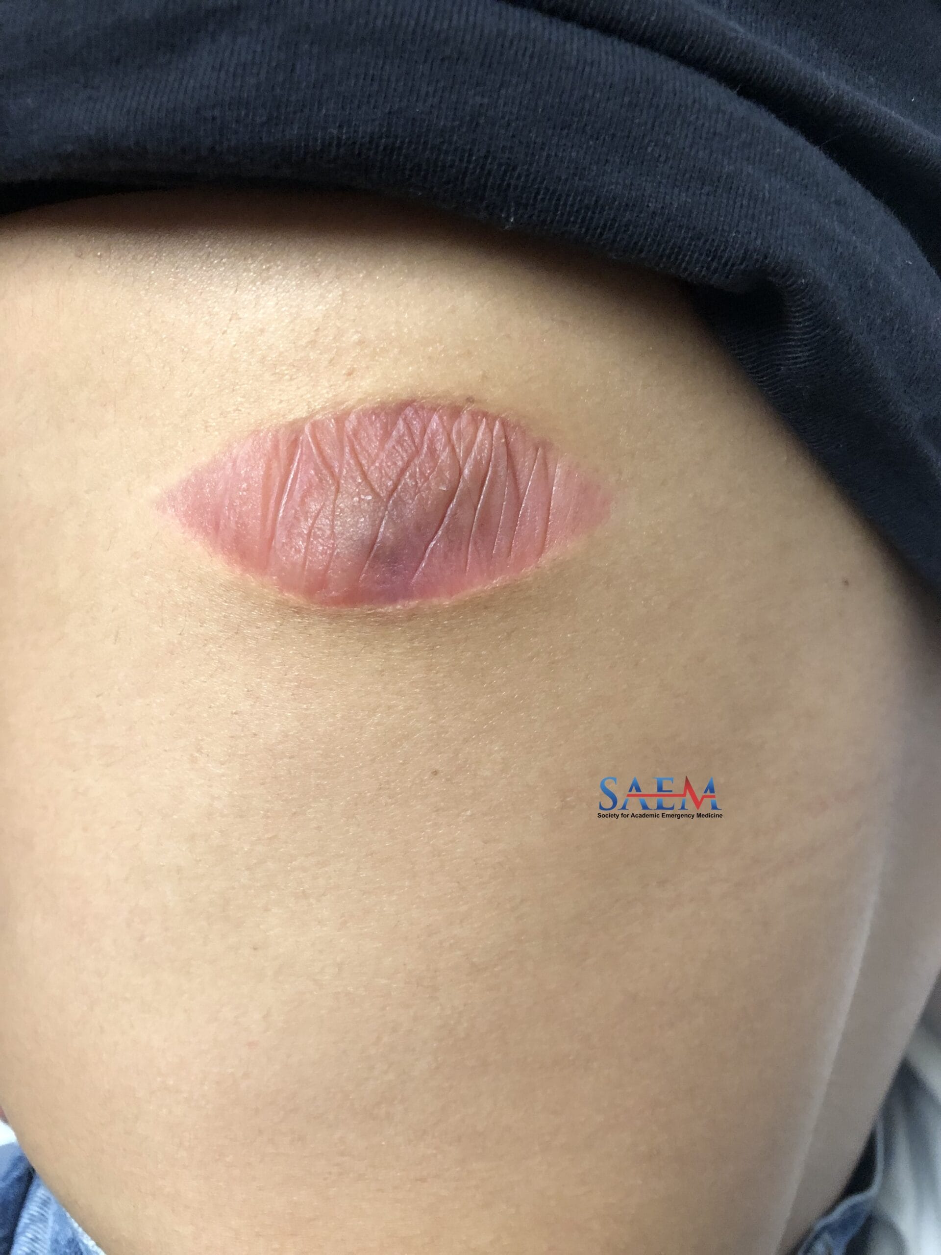 skin lesion