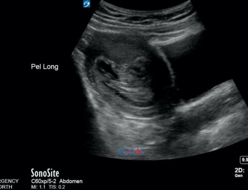 SAEM Clinical Images Series: One Month of Vaginal Bleeding