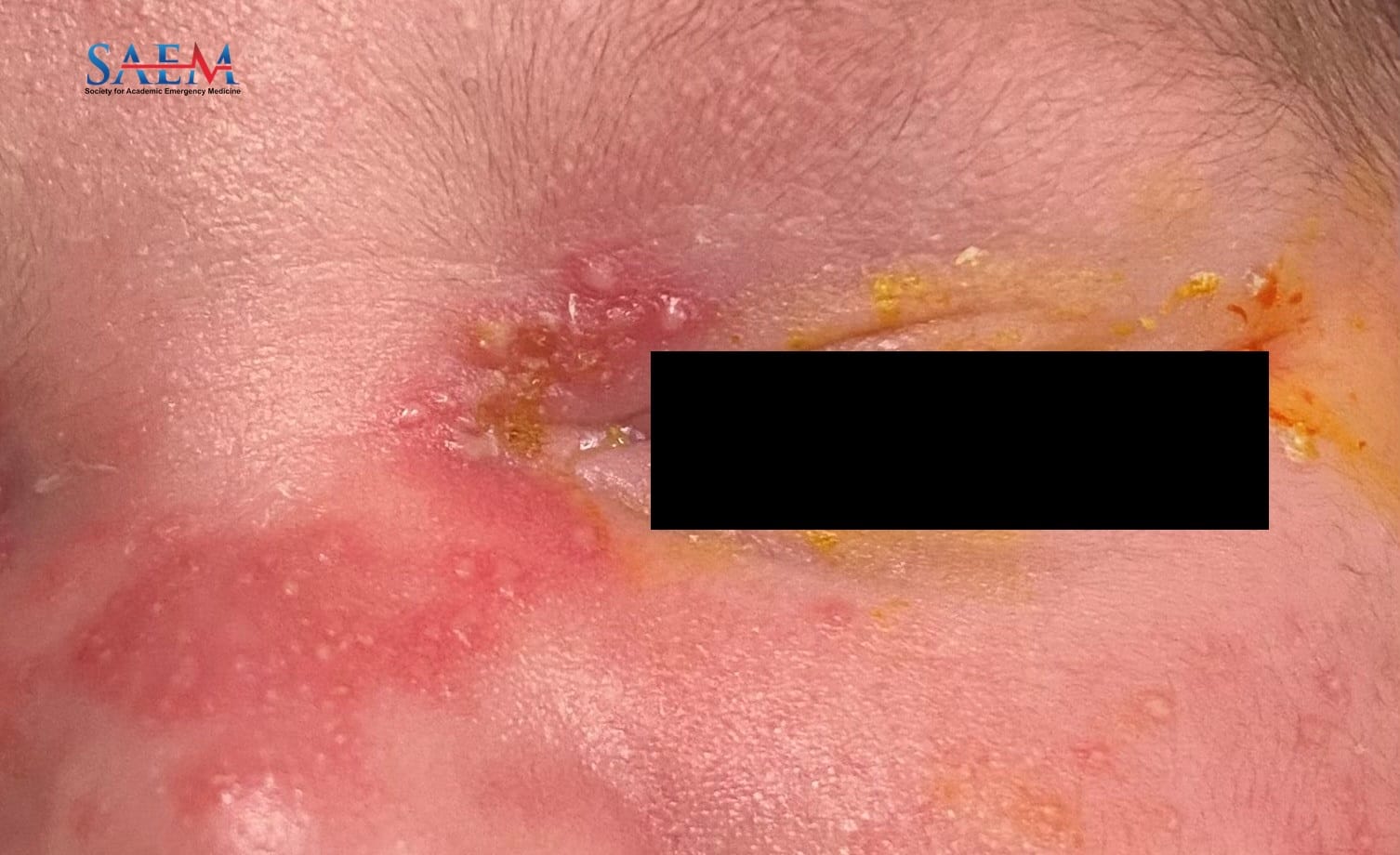 neonatal rash