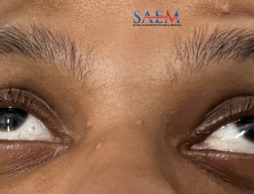 SAEM Clinical Images Series: Not Your Usual Irritated Eye