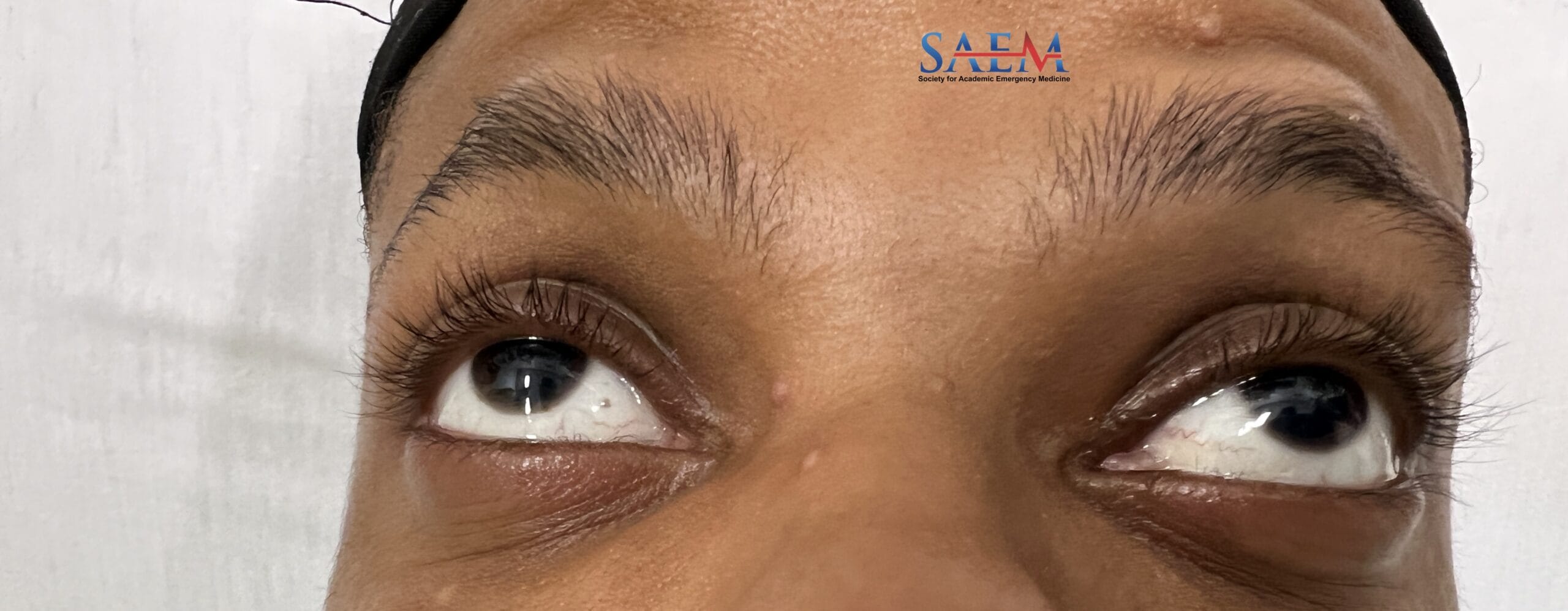 eye irritation