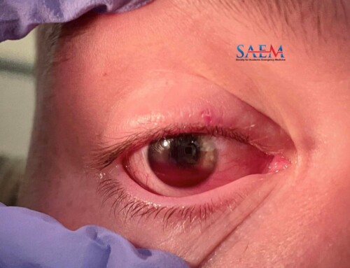 SAEM Clinical Images Series: Workout Gone Wrong