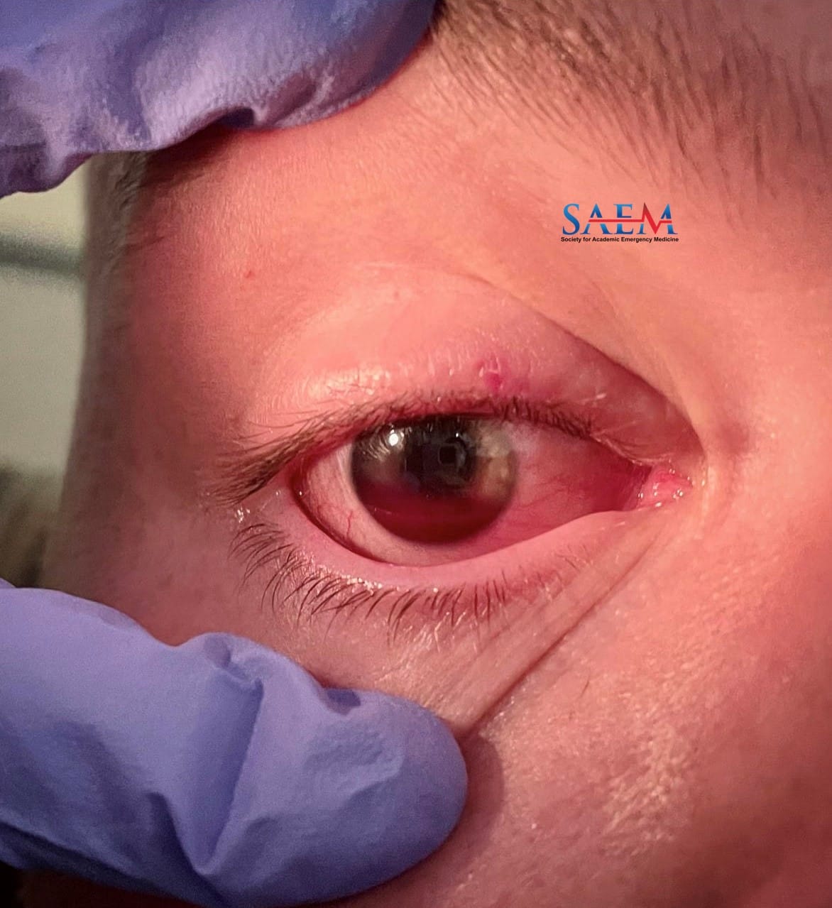 hyphema