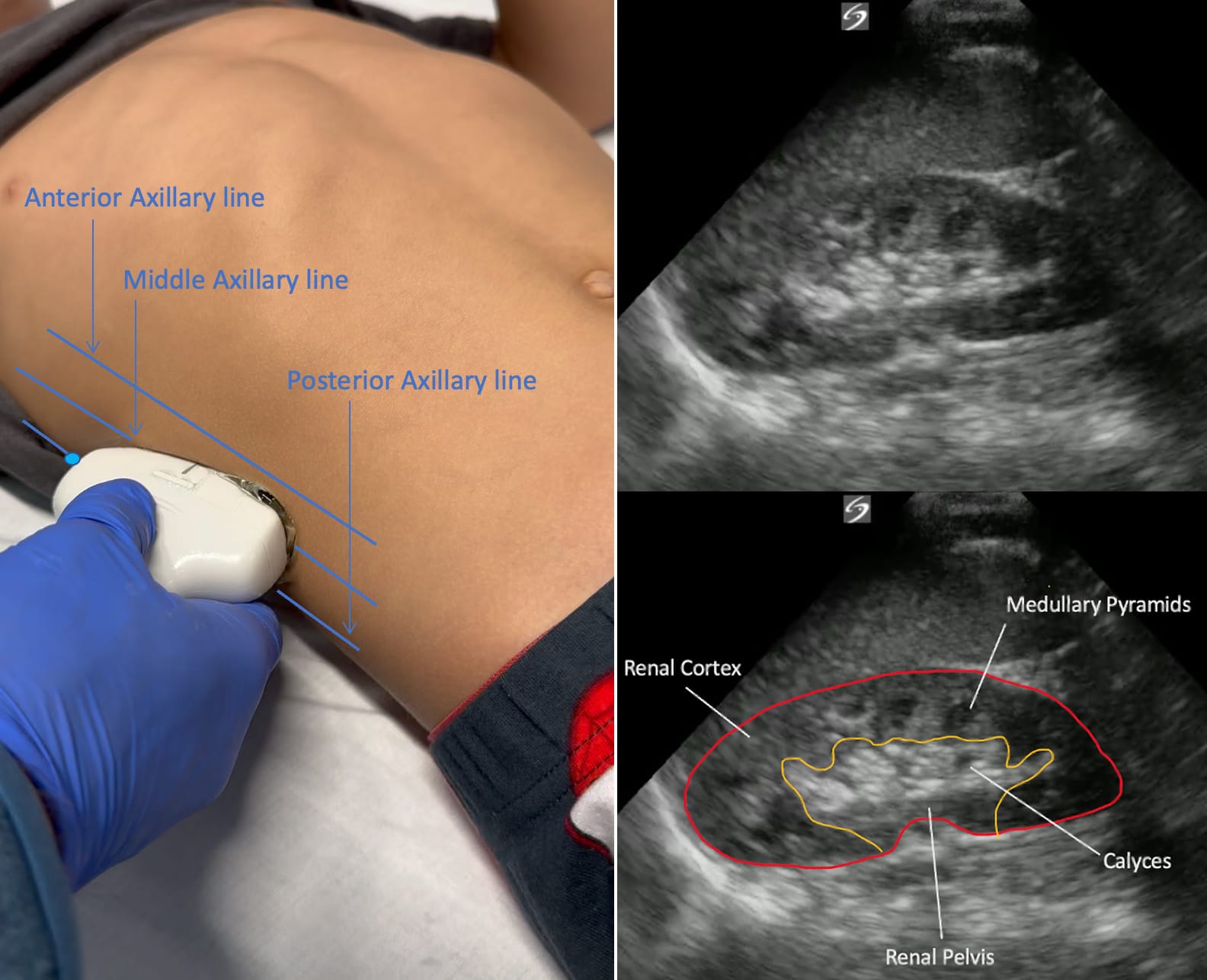 Longitudinal view ultrasound right kidney