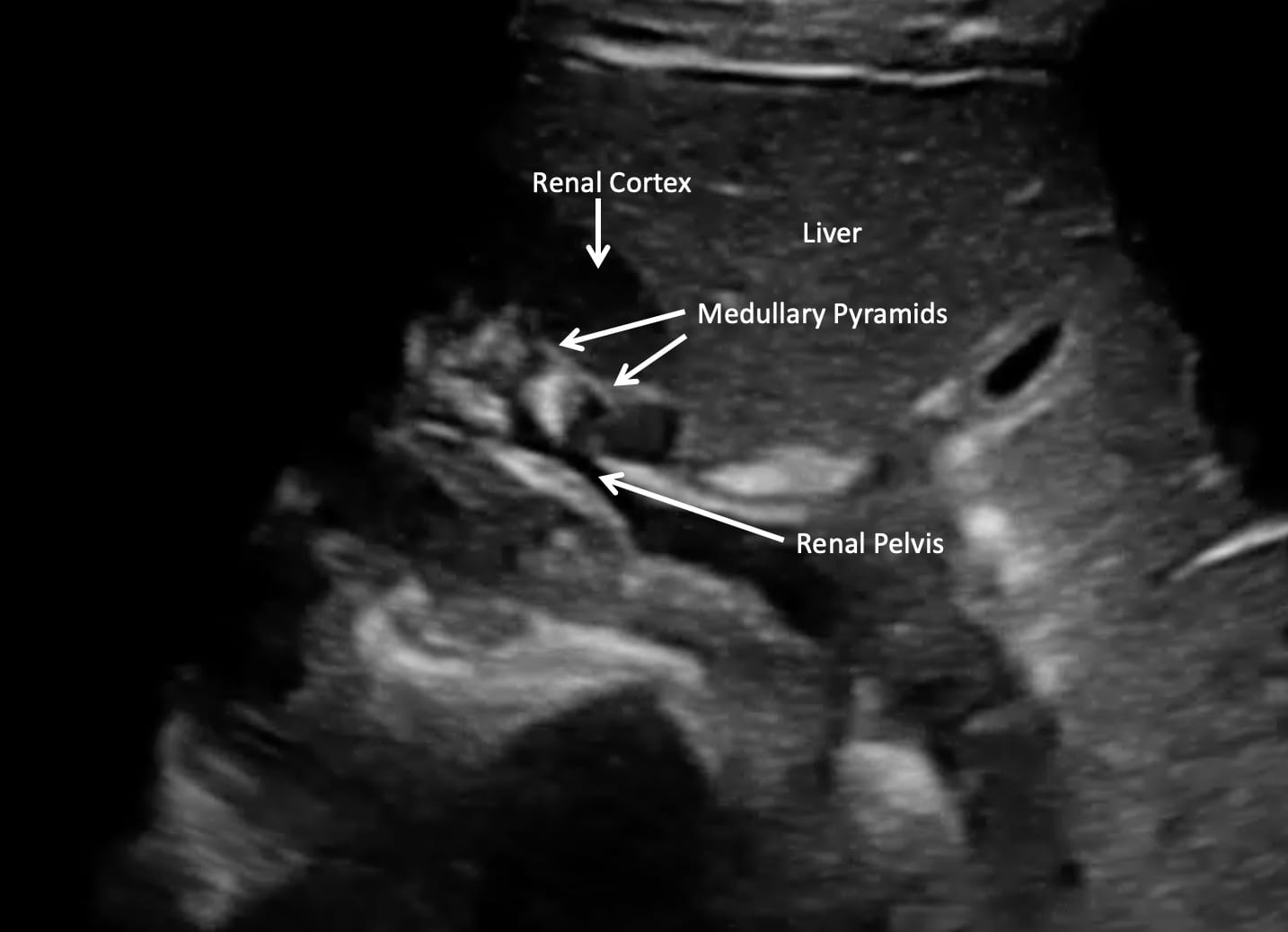right kidney ultrasound transverse view
