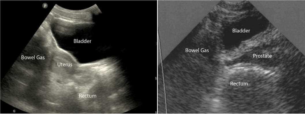 bladder longitudinal sagittal view