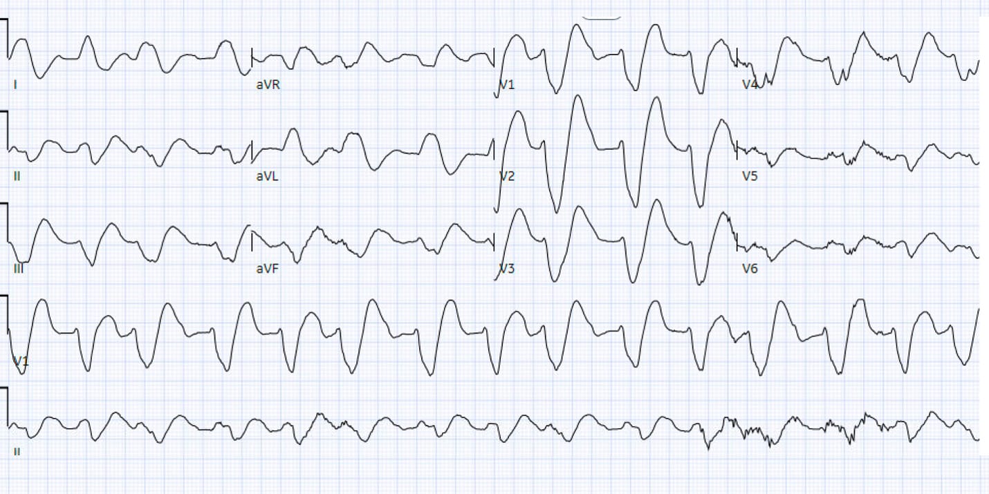 flecainide toxicity acmt ecg