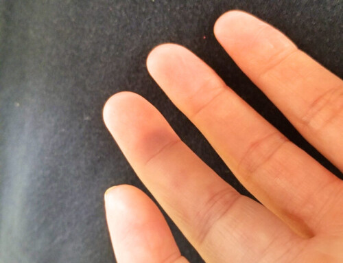 SAEM Clinical Images Series: Purple Finger