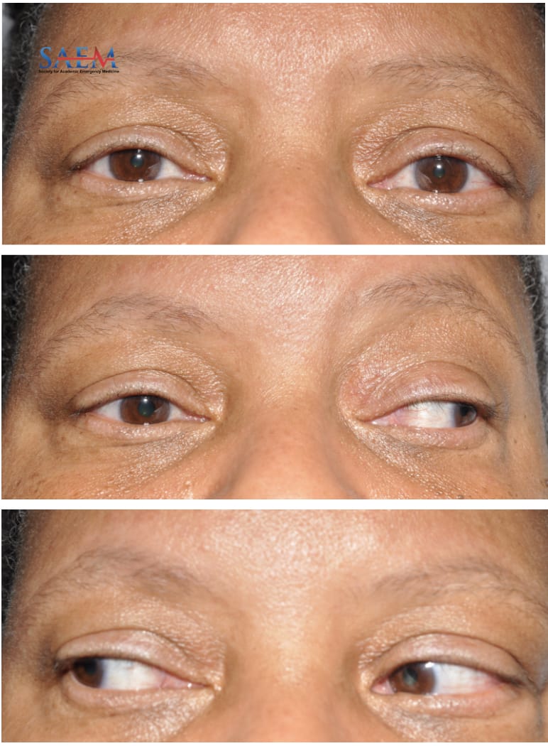 ophthalmoplegia