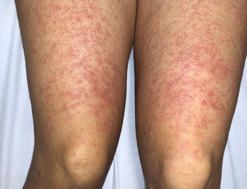 SAEM Clinical Images Series: Red Rash on My Legs