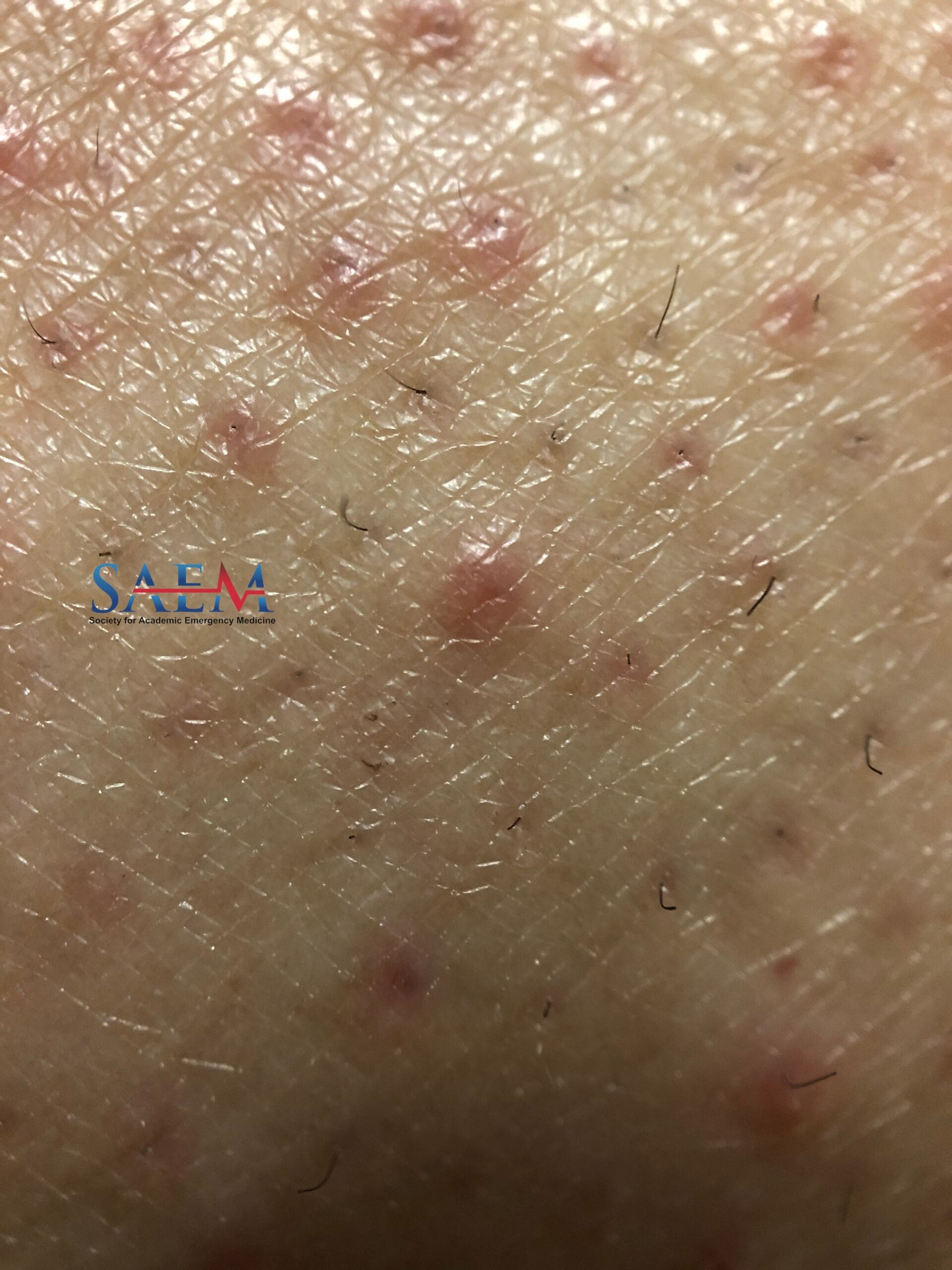 rash