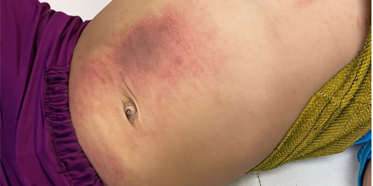 Abdominal Bruising