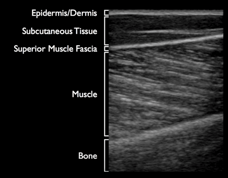 soft tissue layers ultrasound