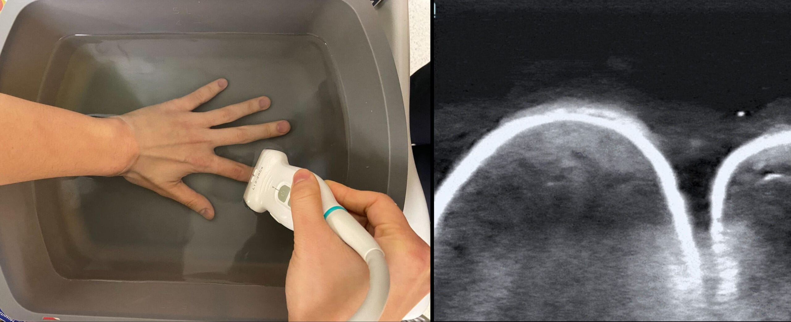 waterbath technique with ultrasound image
