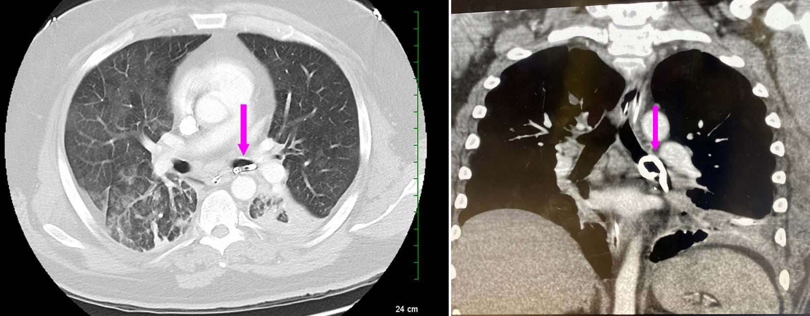 pigtail catheter chest ct in bronchus