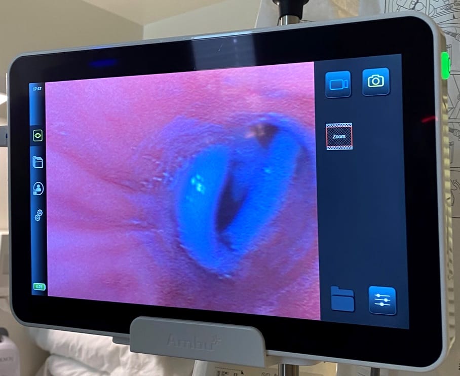 bronchoscopy pigtail