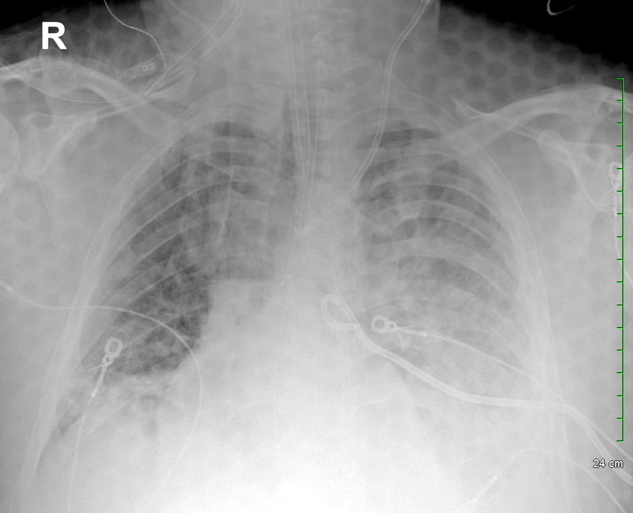 pleural effusion chest x-ray pigtail catheter