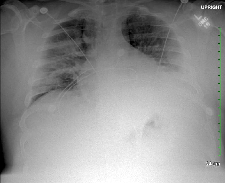 pleural effusion chest x-ray