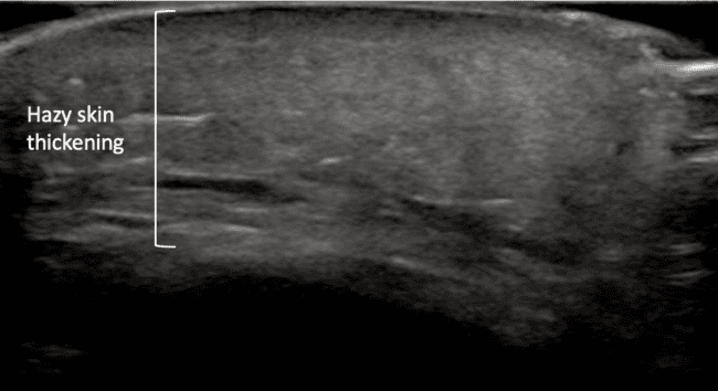 pem pocus cellulitis hazy thickening