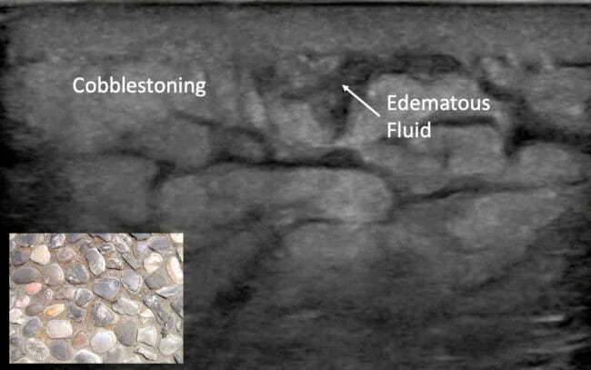 pem pocus cellulitis cobblestoning
