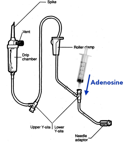 adenosine iv tubing in y-injection site port