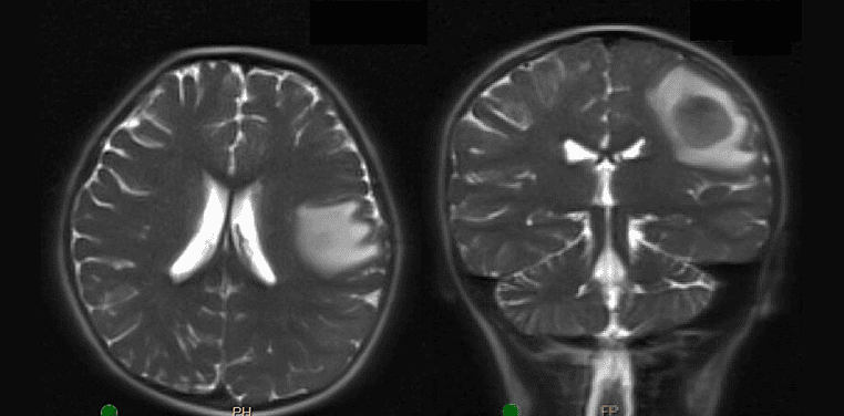 pediatric intracranial hemorrhage on MRI