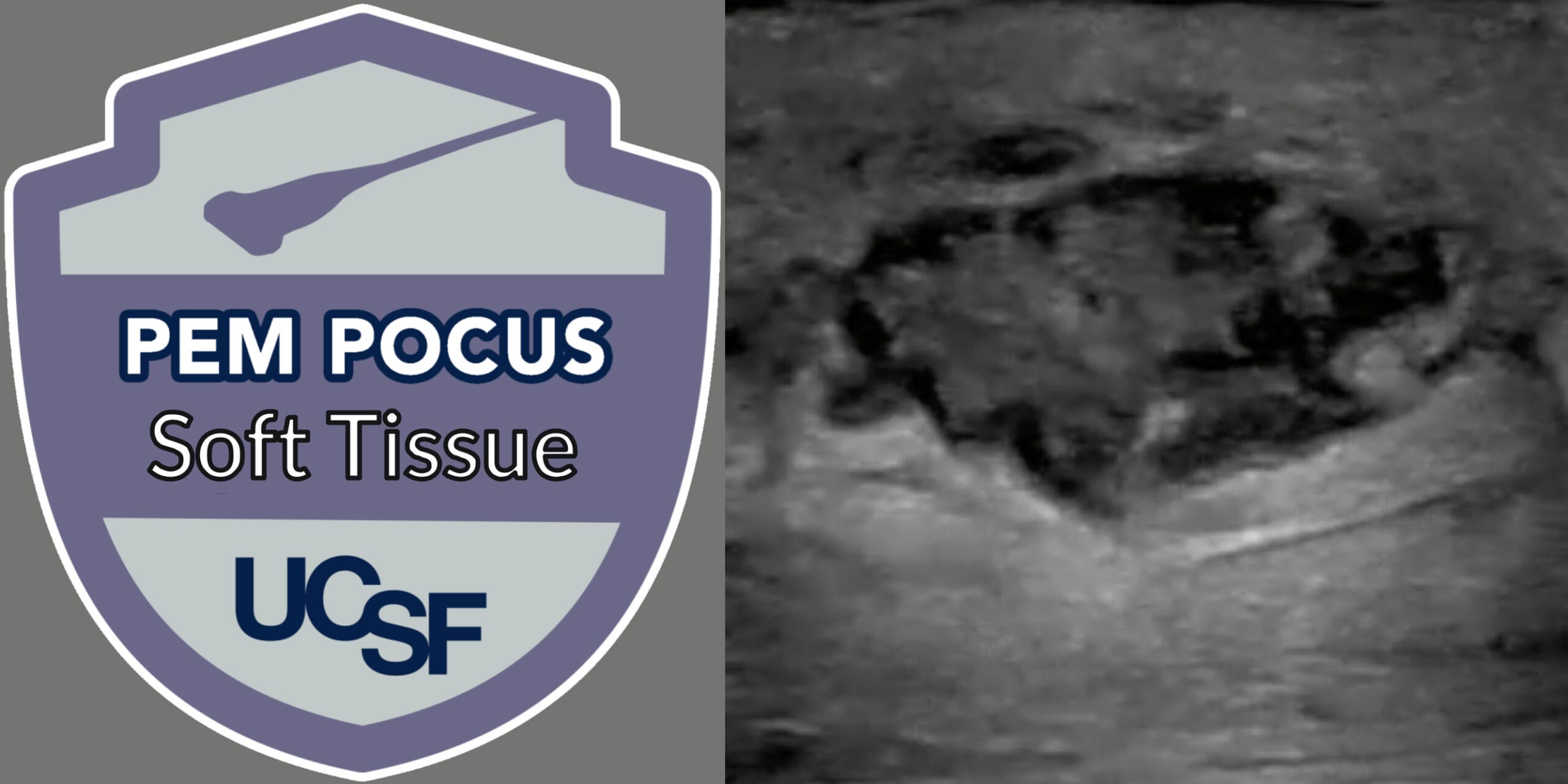 pem pocus soft tissue badge and abscess