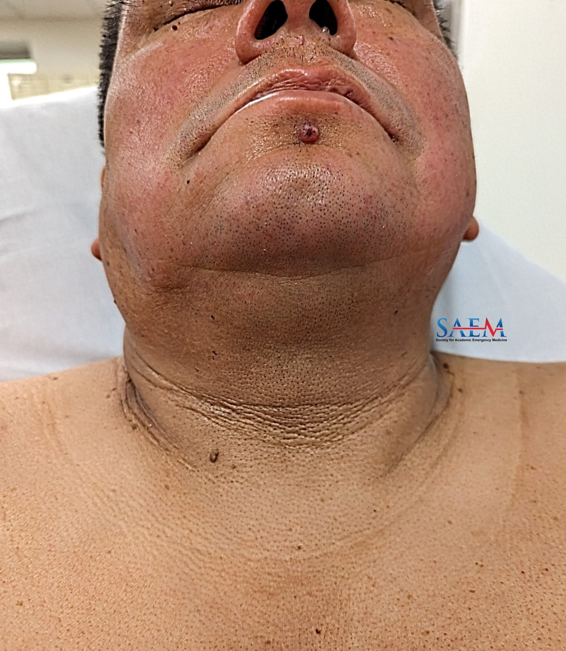 neck swelling
