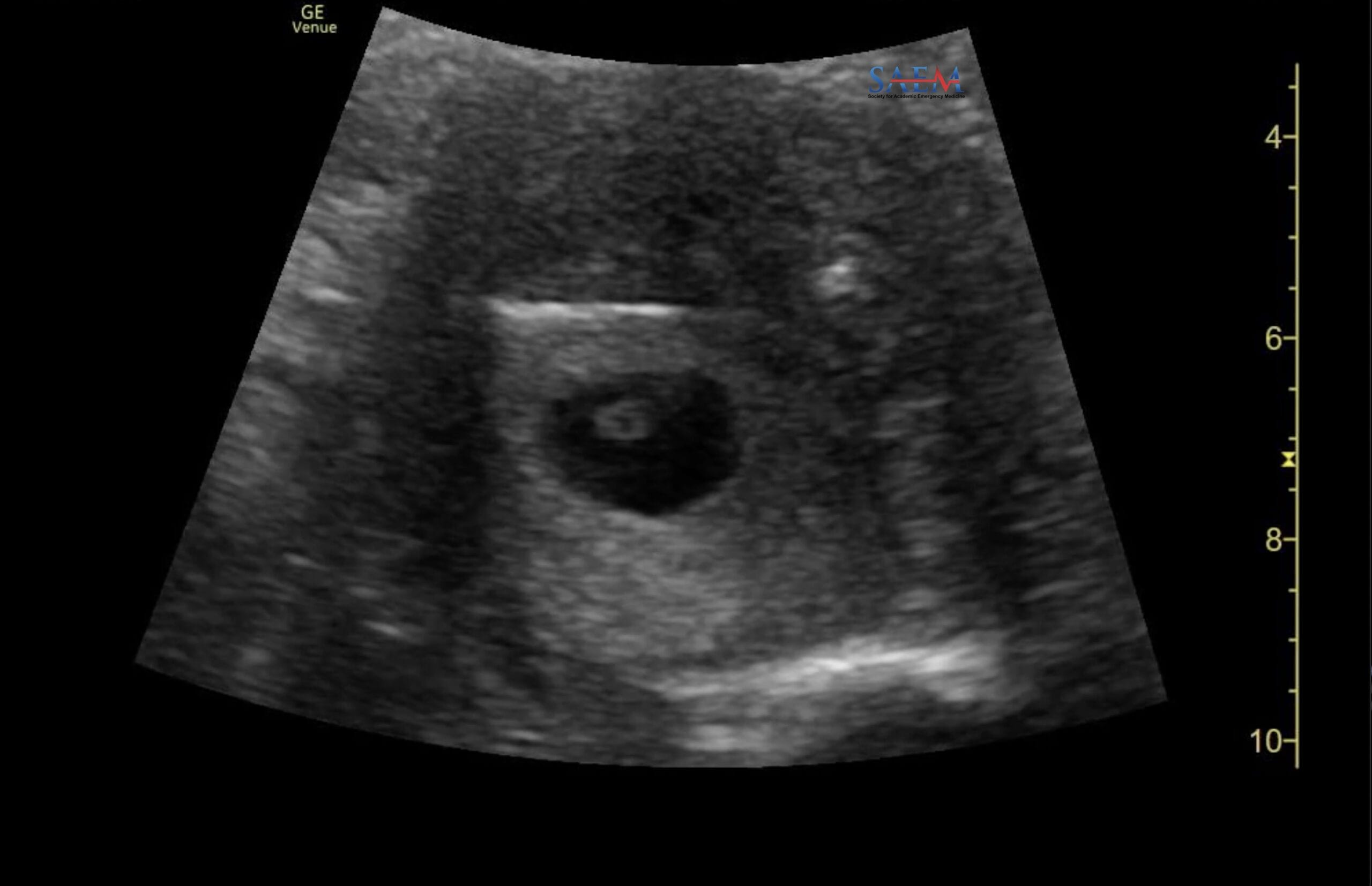 gestational sac