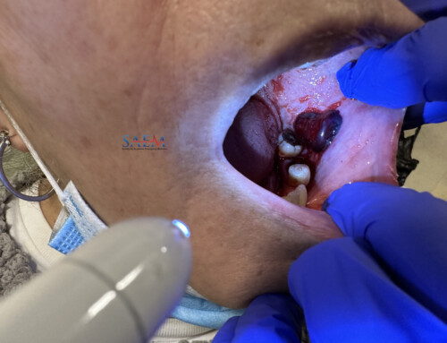 SAEM Clinical Images Series: A Blistery Mystery