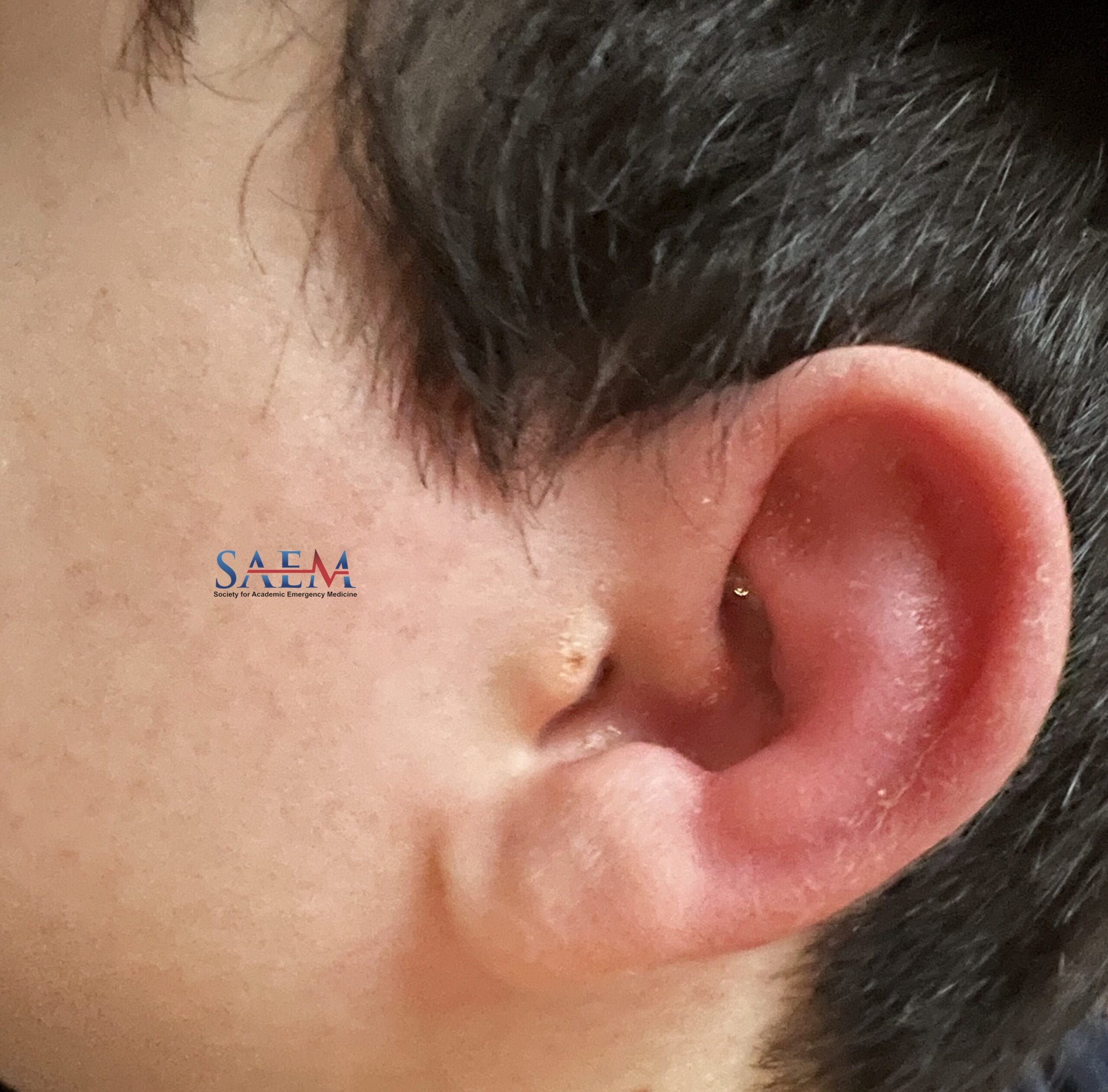 ear infection