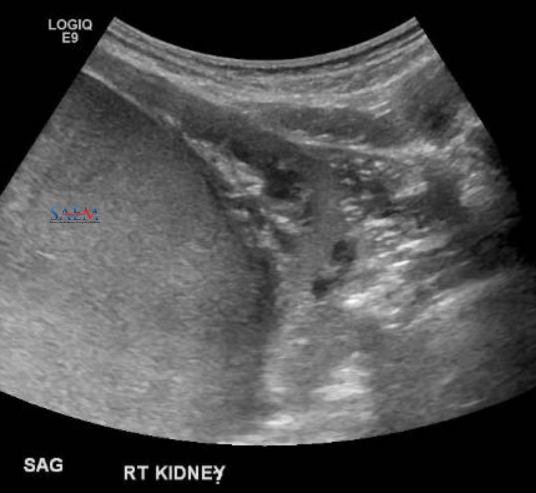kidney