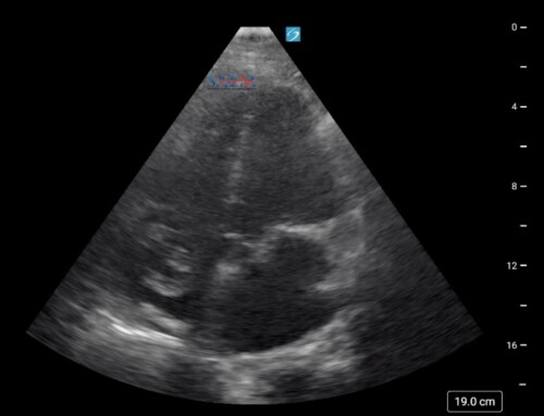 SAEM Clinical Images Series: Clot in Transit