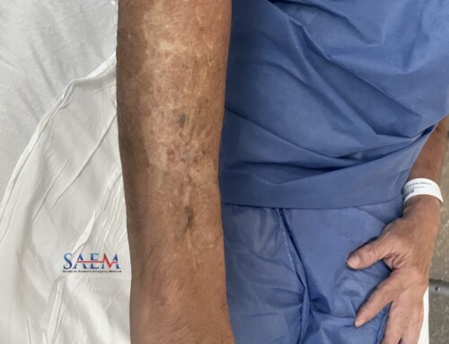 SAEM Clinical Images Series: When Needles Go Beyond Sewing and Acupuncture