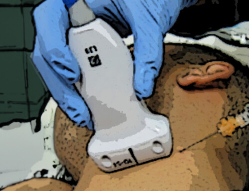 Trick of the Trade: Cut IV extension tubing for 2-person ultrasound guided nerve block