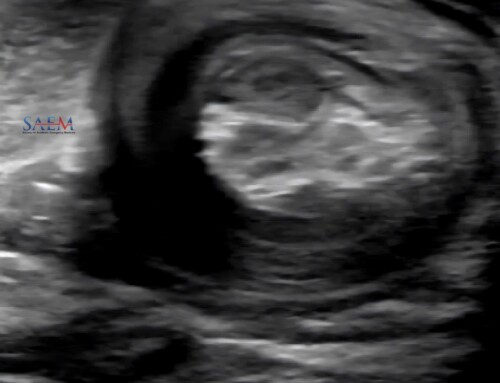 SAEM Clinical Images Series: Rectal Bulge