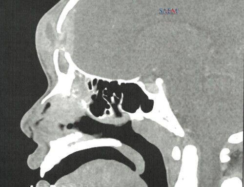 SAEM Clinical Images Series: Pediatric Forehead Swelling