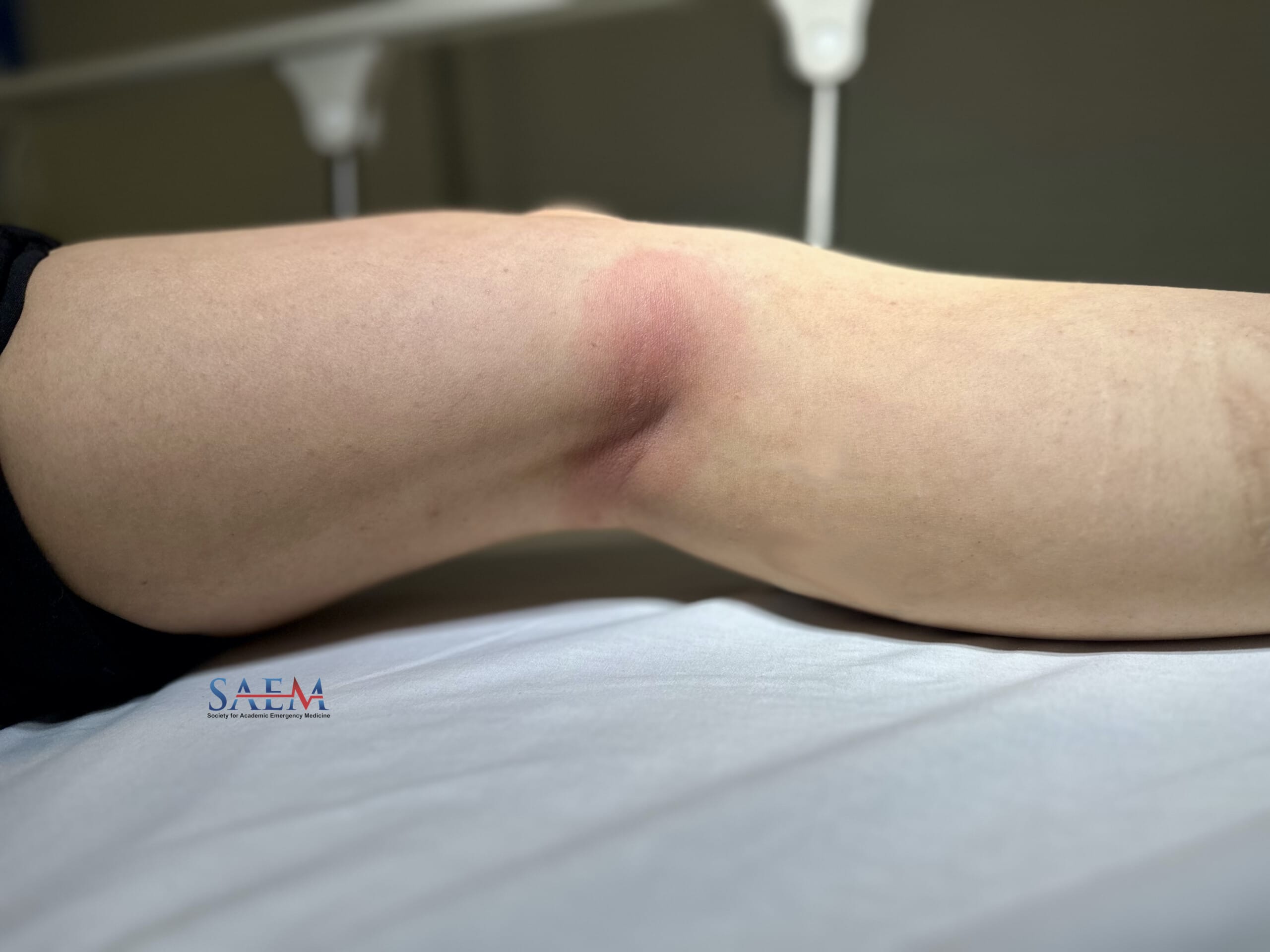 erythema