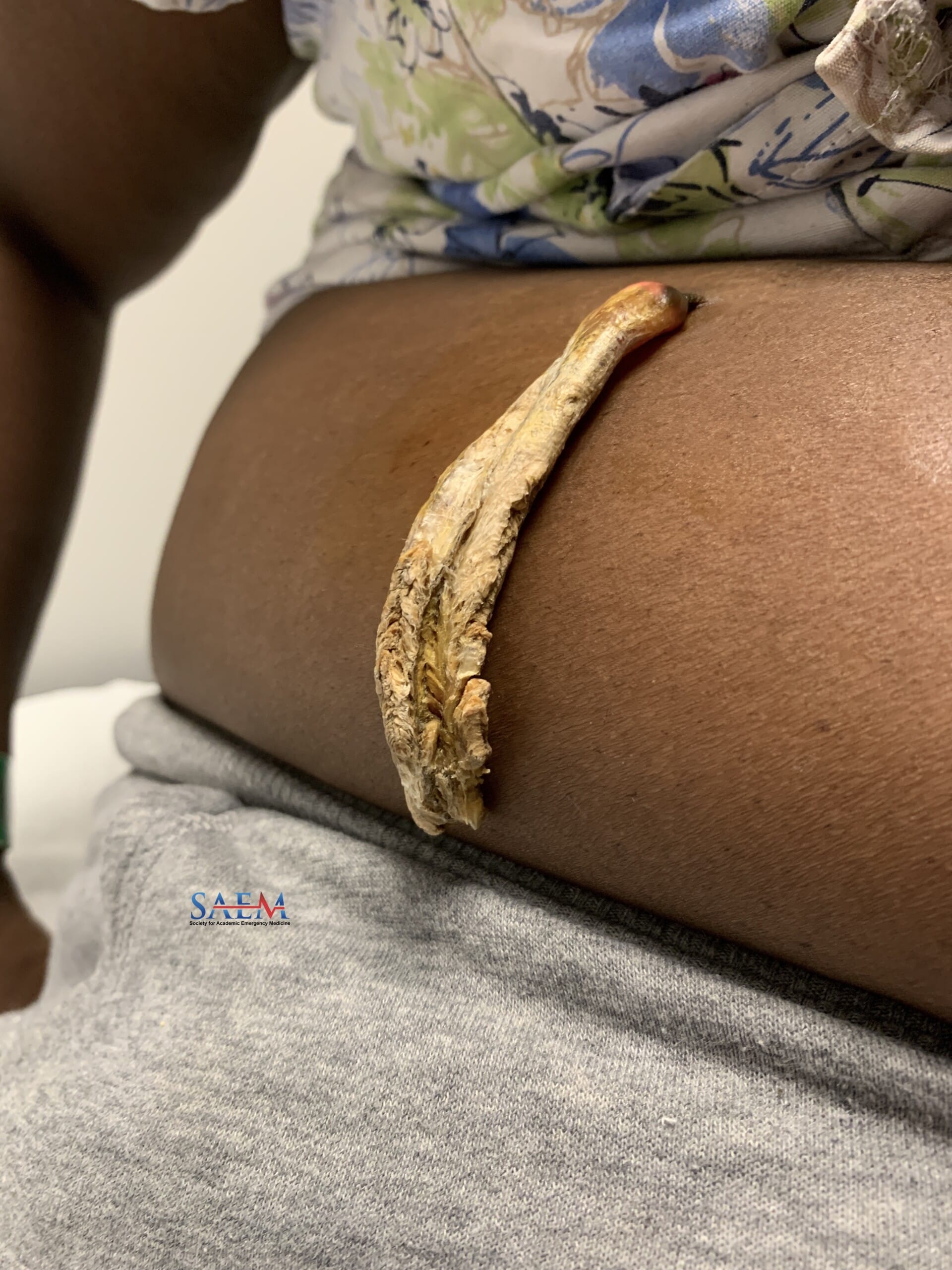 cutaneous horn