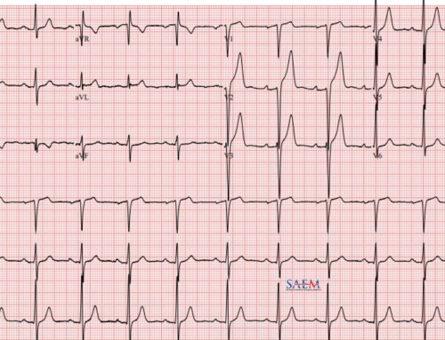 SAEM Clinical Images Series: Male Weightlifter with Chest Pain