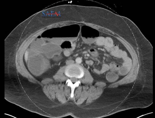 SAEM Clinical Images Series: A Rare Gastrointestinal Complication of an Endocrine Emergency