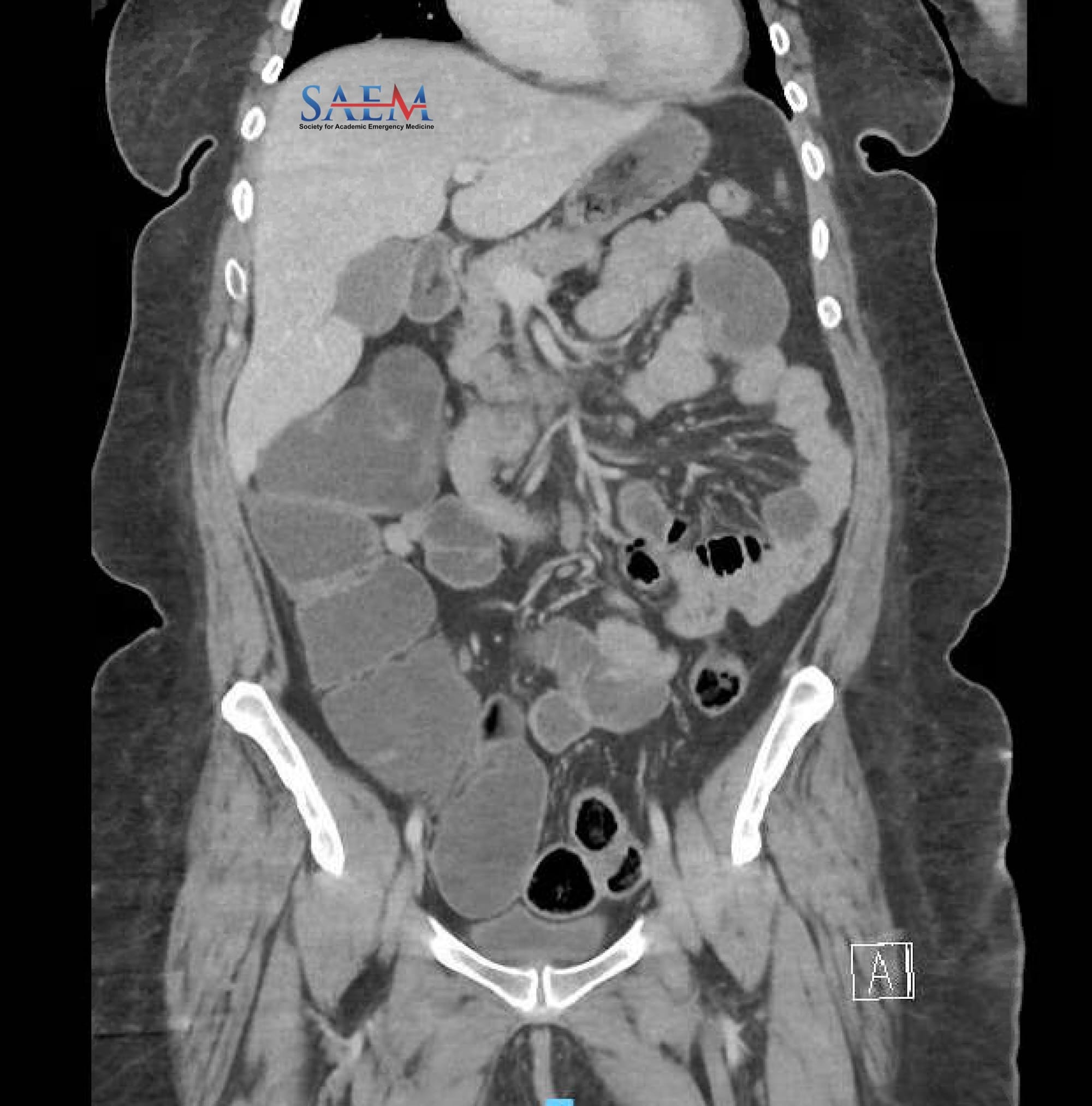ogilvie syndrome