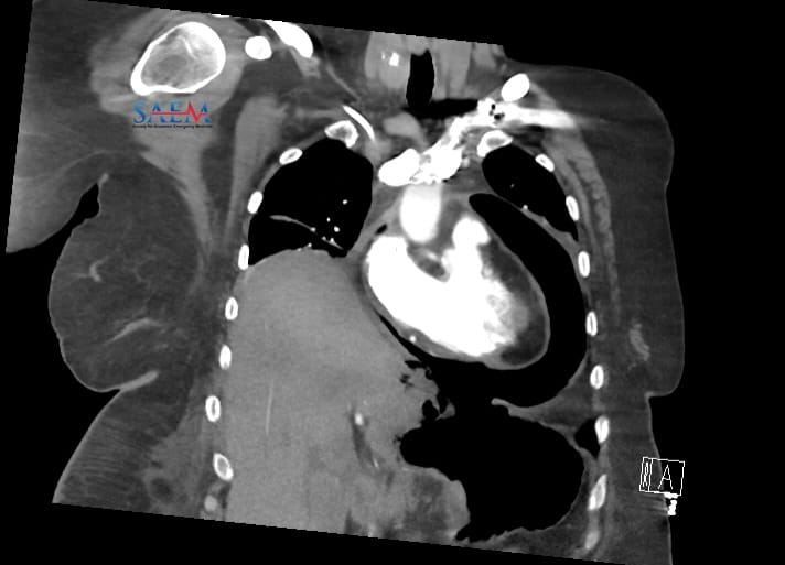 pneumopericardium
