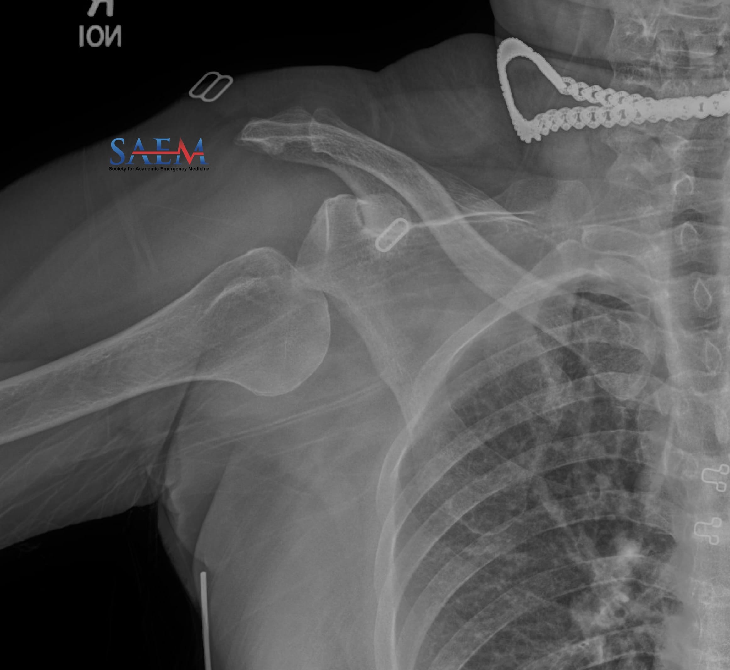 dislocation