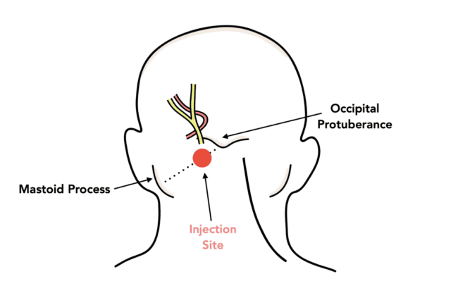 surface anatomy injection site for greater occipital nerve block