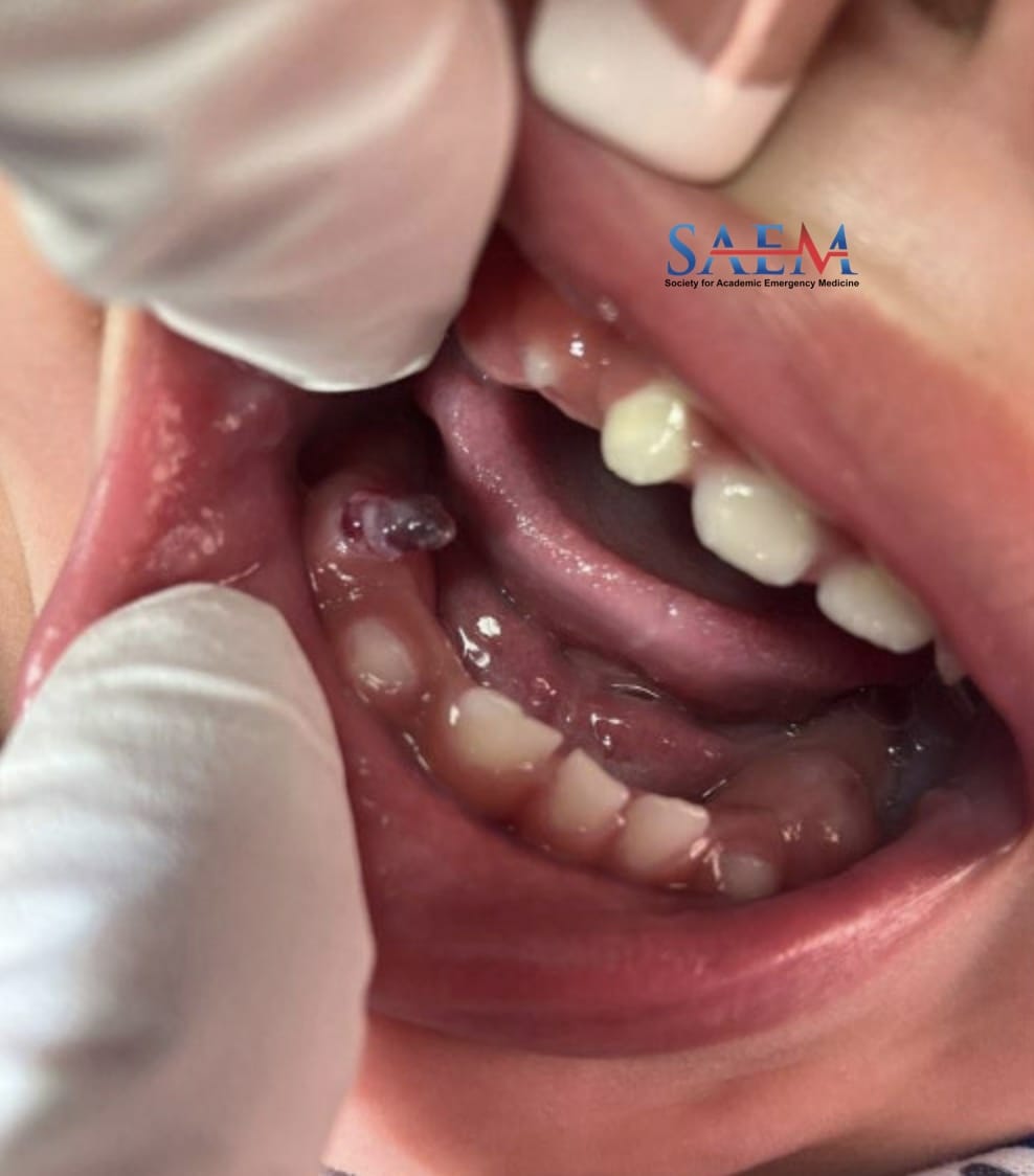 cyst