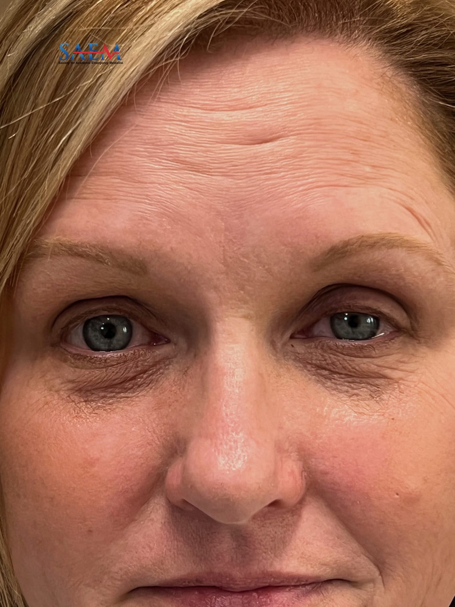 ptosis