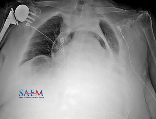 SAEM Clinical Images Series: A Rare Cause of Dyspnea